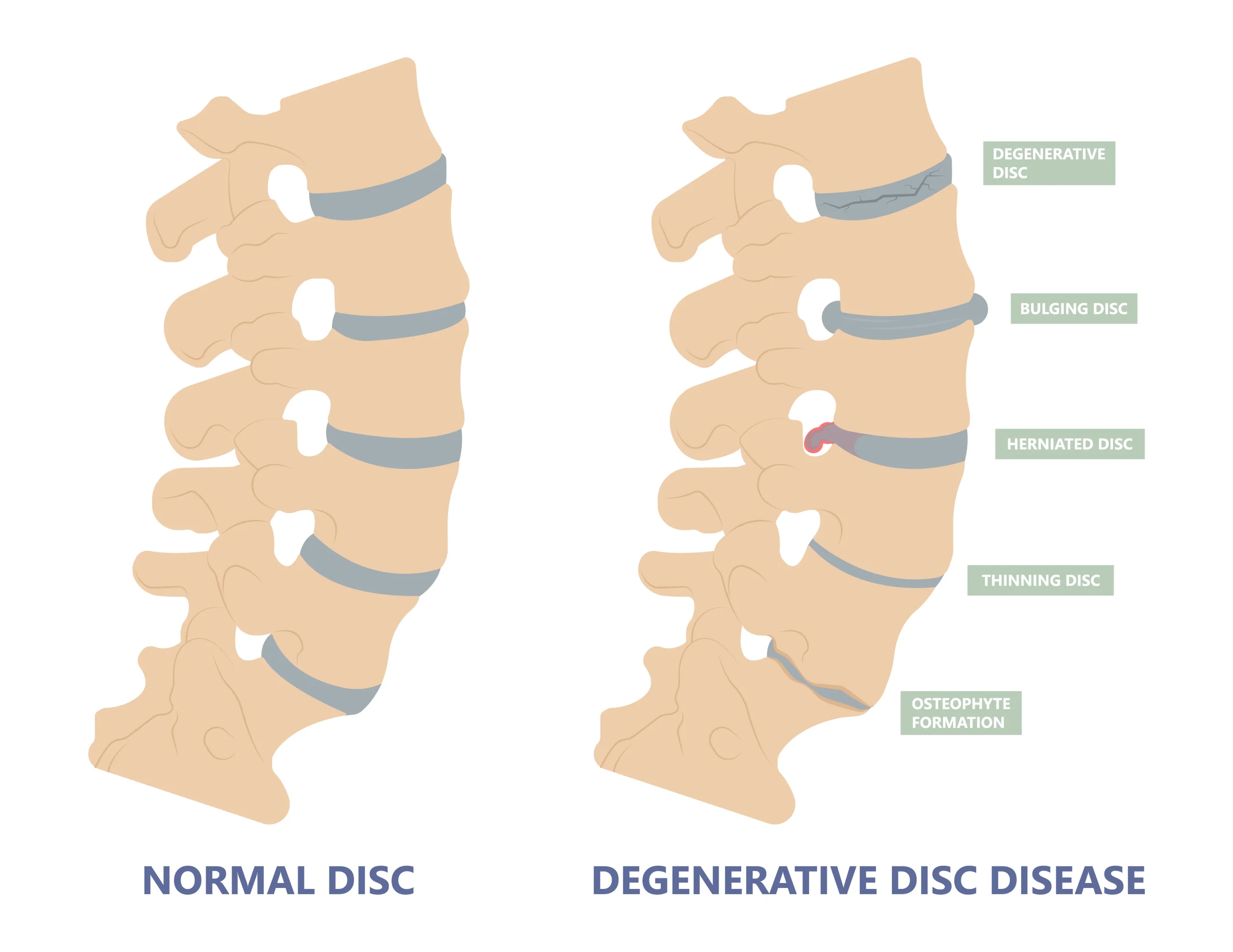 cervical degenerative disc disease