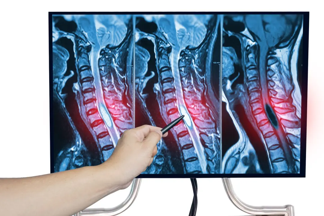 slip disc treatment